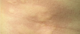Urticaria Treatment: Medical And Natural Solutions That Help Treat Hives